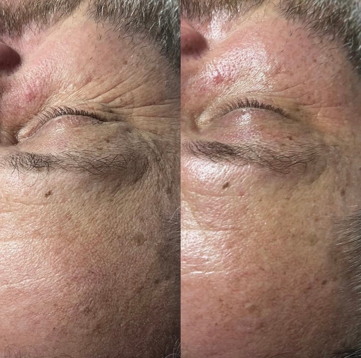 Before and after one nano needling facial: the skin around the eye and cheek, smoother and brighter